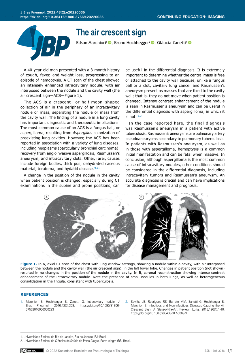 Jornal Brasileiro de Pneumologia - Intracavitary nodule