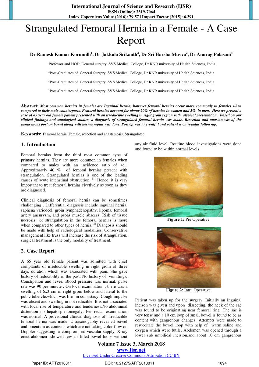 PDF) Strangulated Femoral Hernia in a Female - A Case Report