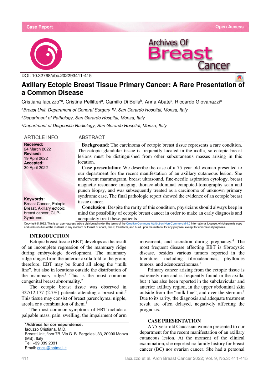 Pdf Axillary Ectopic Breast Tissue Primary Cancer A Rare
