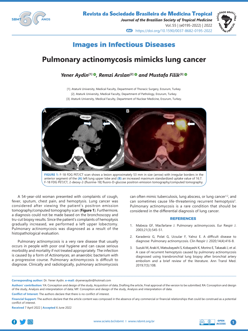 Pdf Pulmonary Actinomycosis Mimicks Lung Cancer