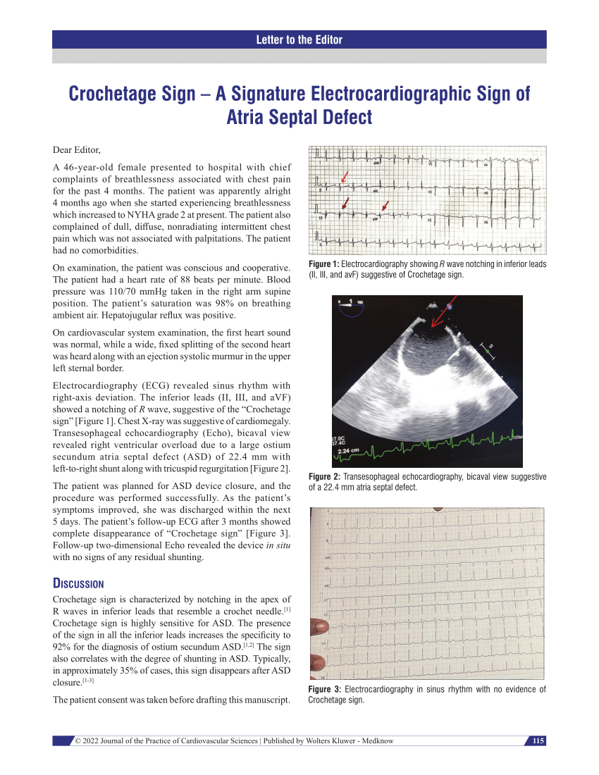 Crochetage sign in atrial septal defect – All About Cardiovascular
