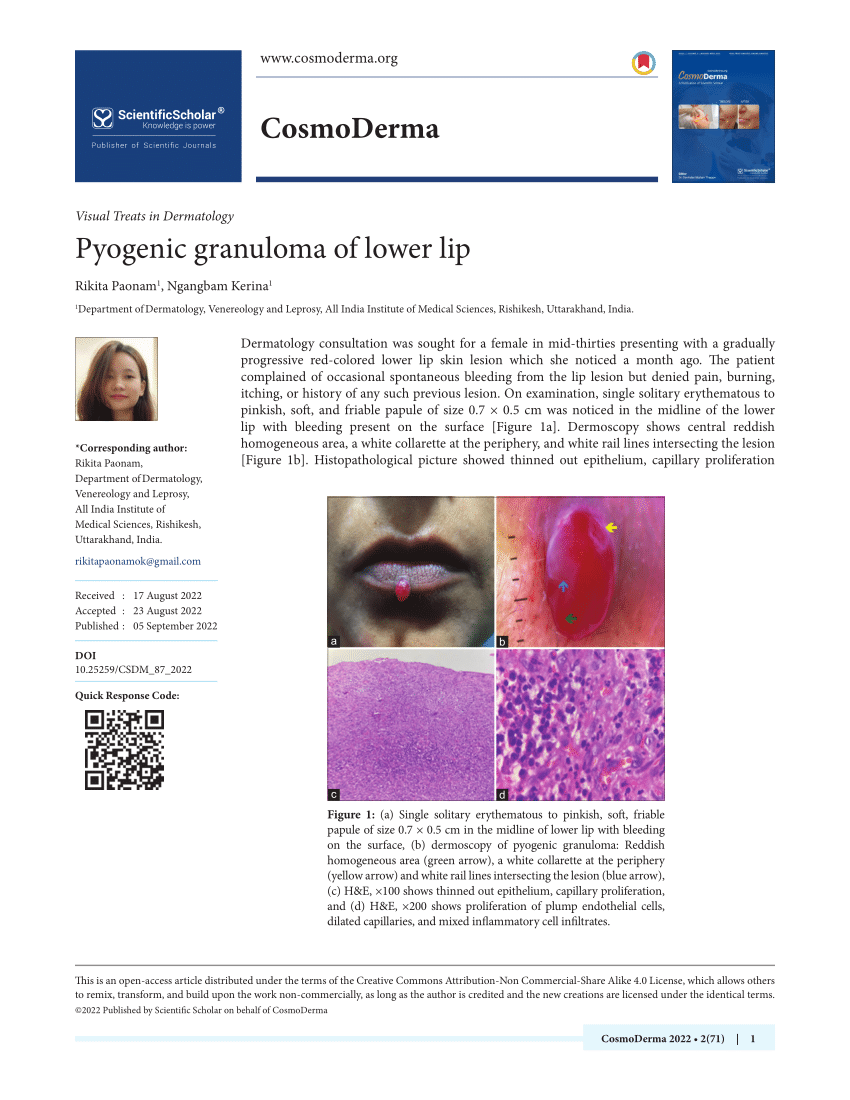 Pdf Pyogenic Granuloma Of Lower Lip