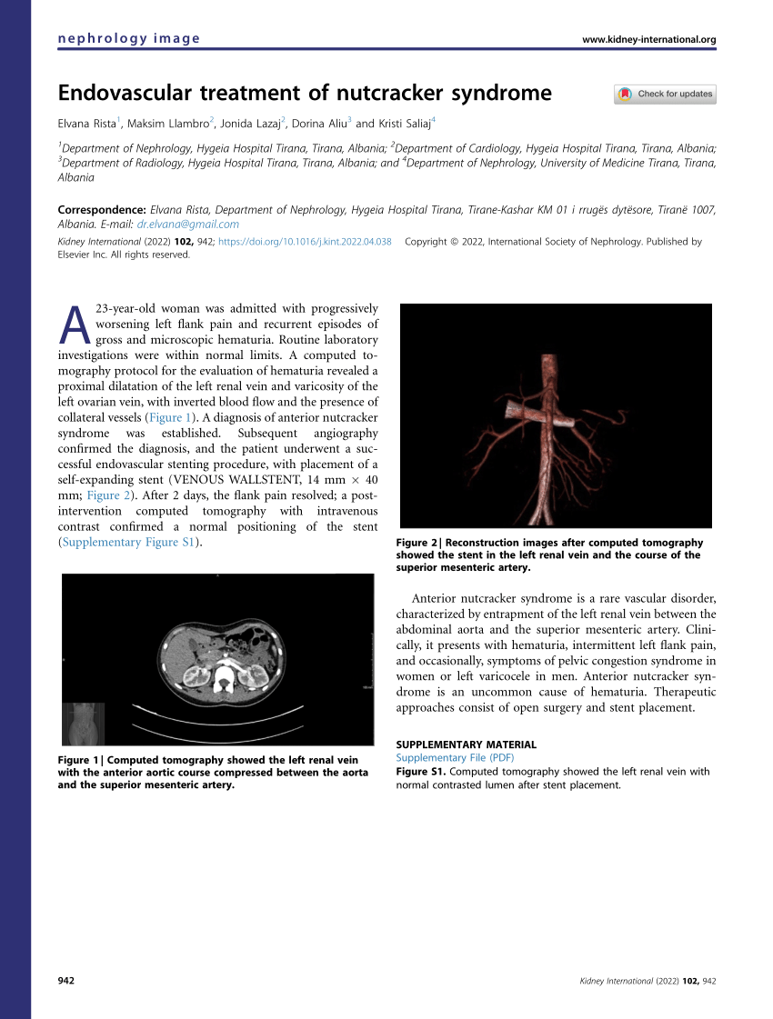 (PDF) Endovascular treatment of nutcracker syndrome