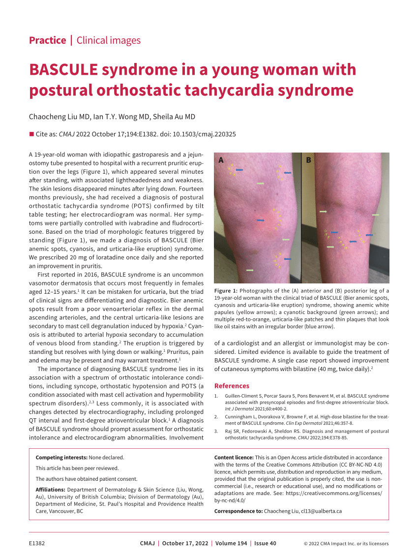 PDF] Acrocyanosis Presentation in Postural Orthostatic Tachycardia