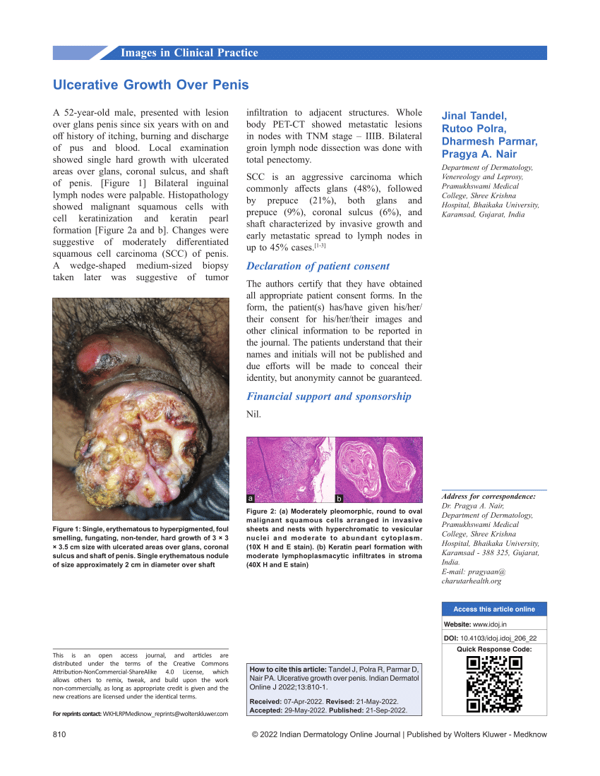 PDF Ulcerative Growth Over Penis