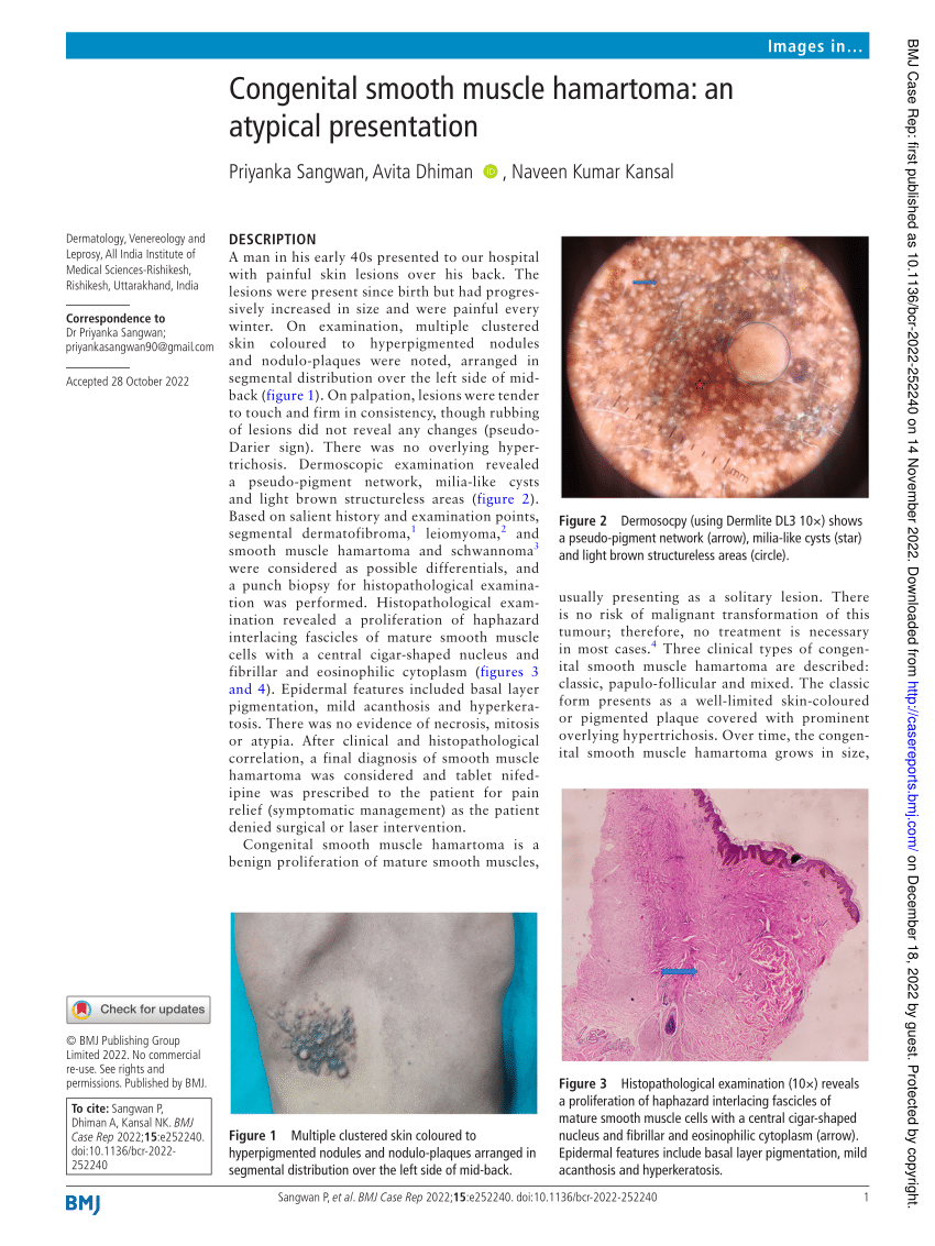 Pdf Congenital Smooth Muscle Hamartoma An Atypical Presentation 