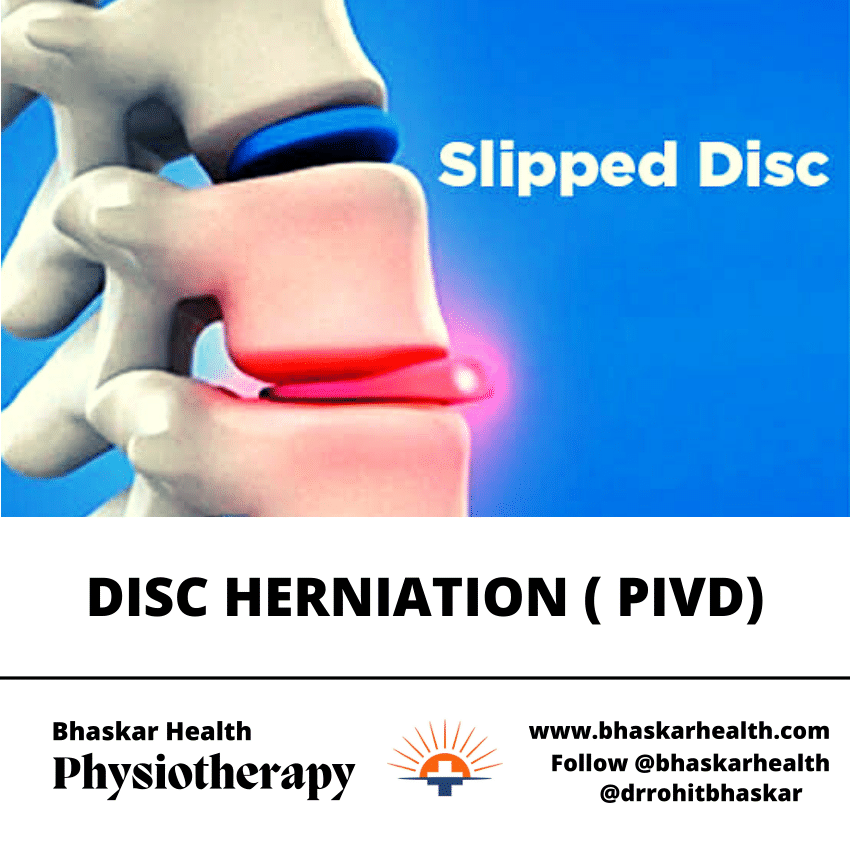 Pdf Pivd Slipped Or Herniated Disc Physiotherapy Treatment