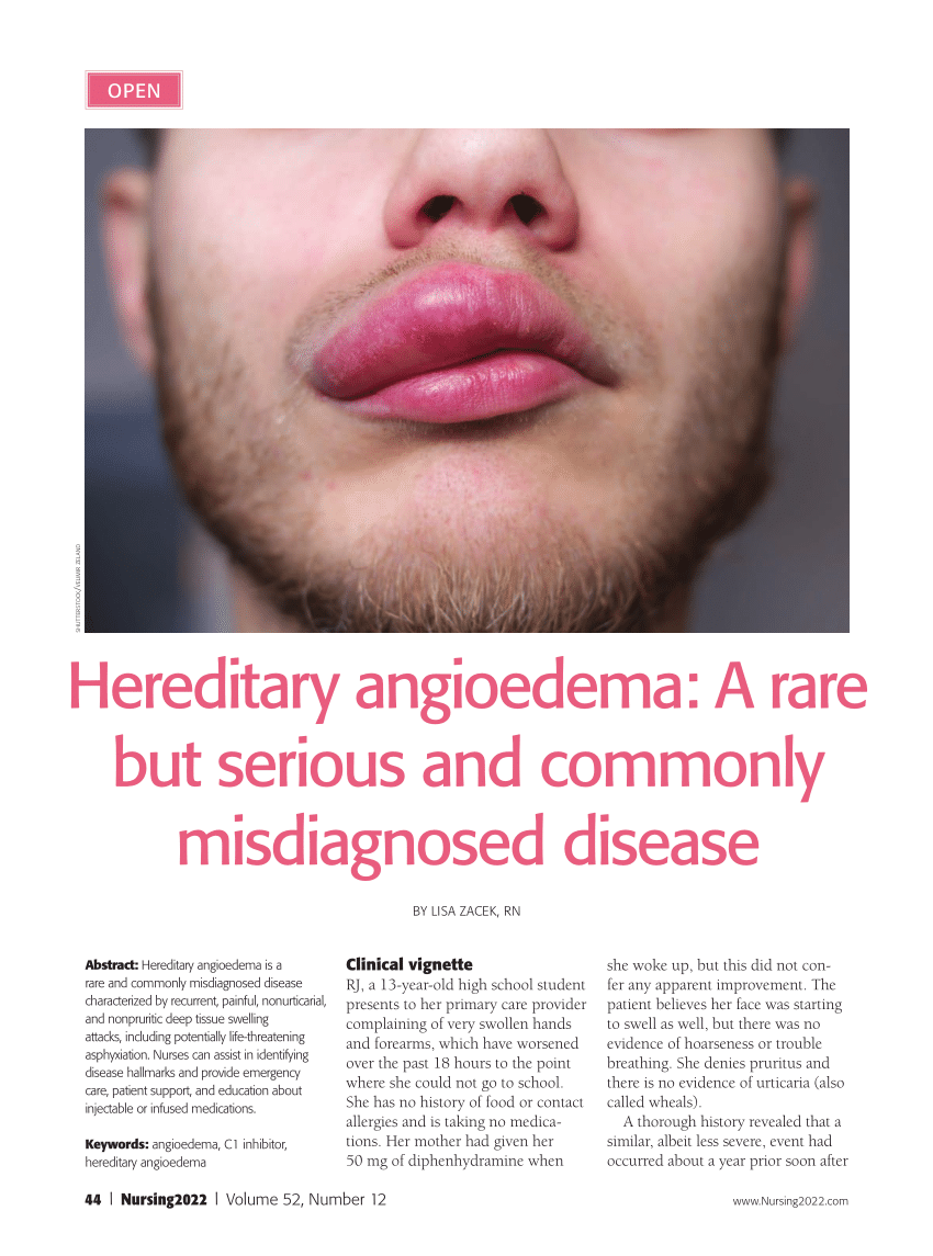 Pdf Hereditary Angioedema A Rare But Serious And Commonly Misdiagnosed Disease 2370