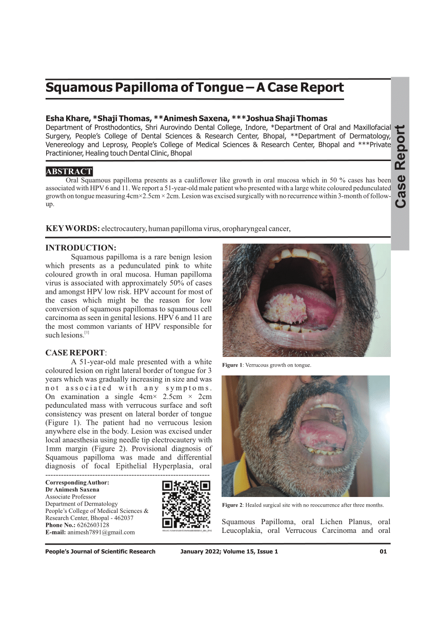 PDF Squamous Papilloma Of Tongue A Case Report