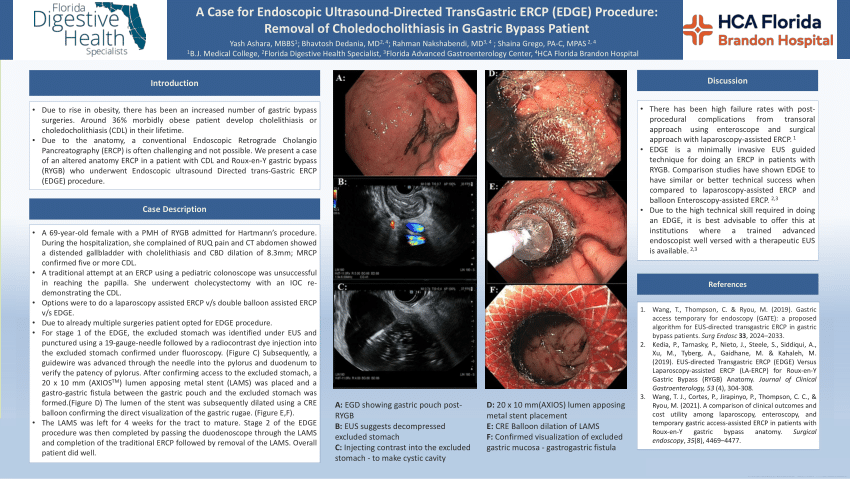 Pdf A Case For Endoscopic Ultrasound Directed Transgastric Ercp Edge Procedure Removal Of 