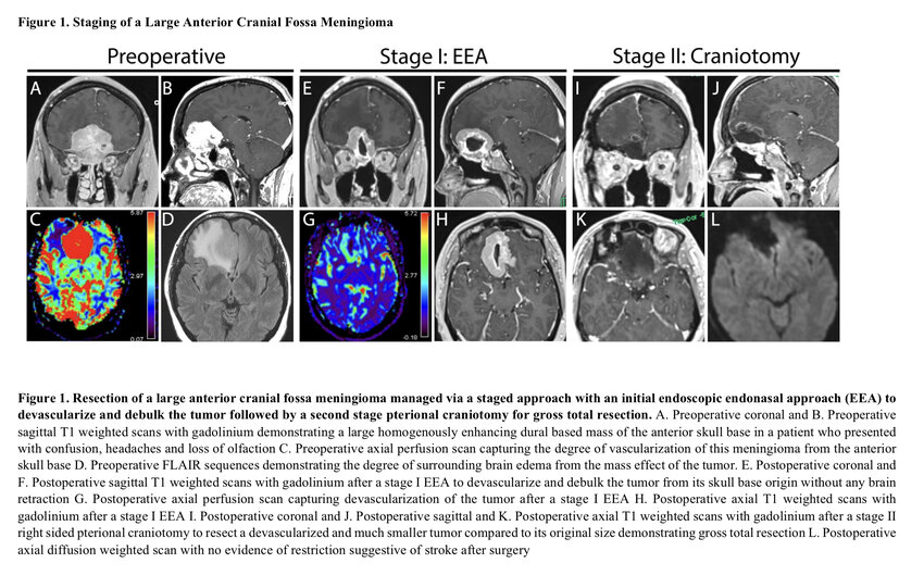 Pdf Staged Resection Of Difficult To Treat Intracranial Meningiomas A Systematic Review Of 4335