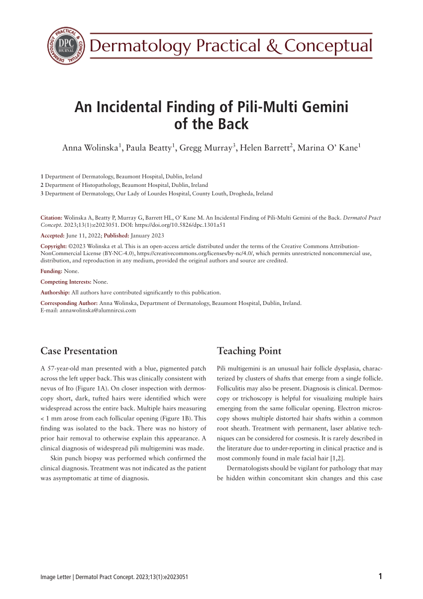 PDF An Incidental Finding of Pili Multi Gemini of the Back