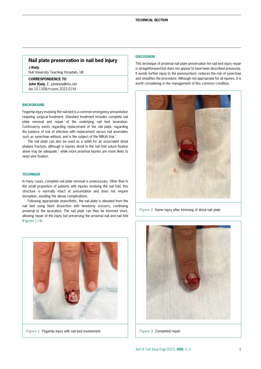 PDF) Nail plate preservation in nail bed injury