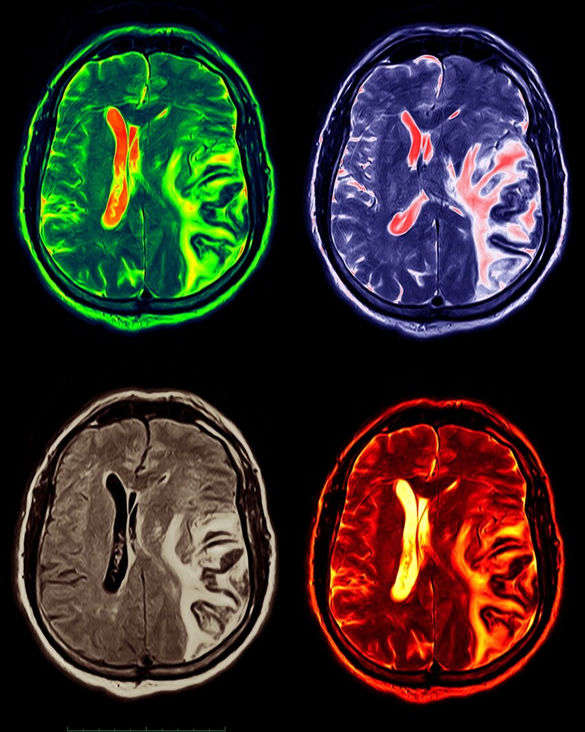 Pdf Hemorrhagic Transformation Ht Of An Ischemic Stroke