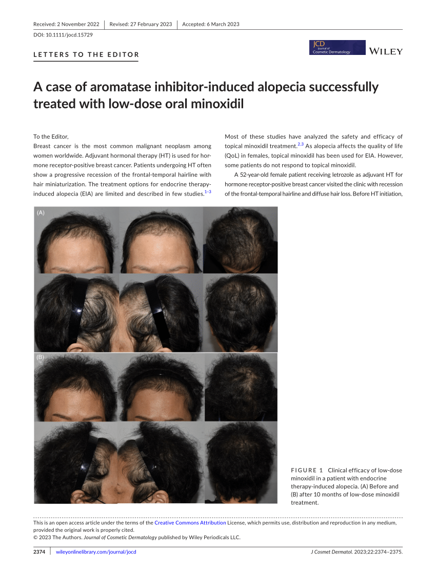 (PDF) A case of aromatase inhibitor‐induced alopecia successfully ...