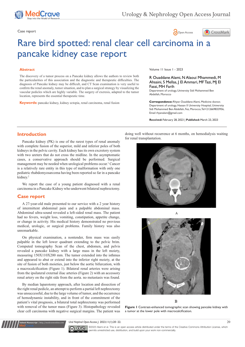 (PDF) Pancake Kidney