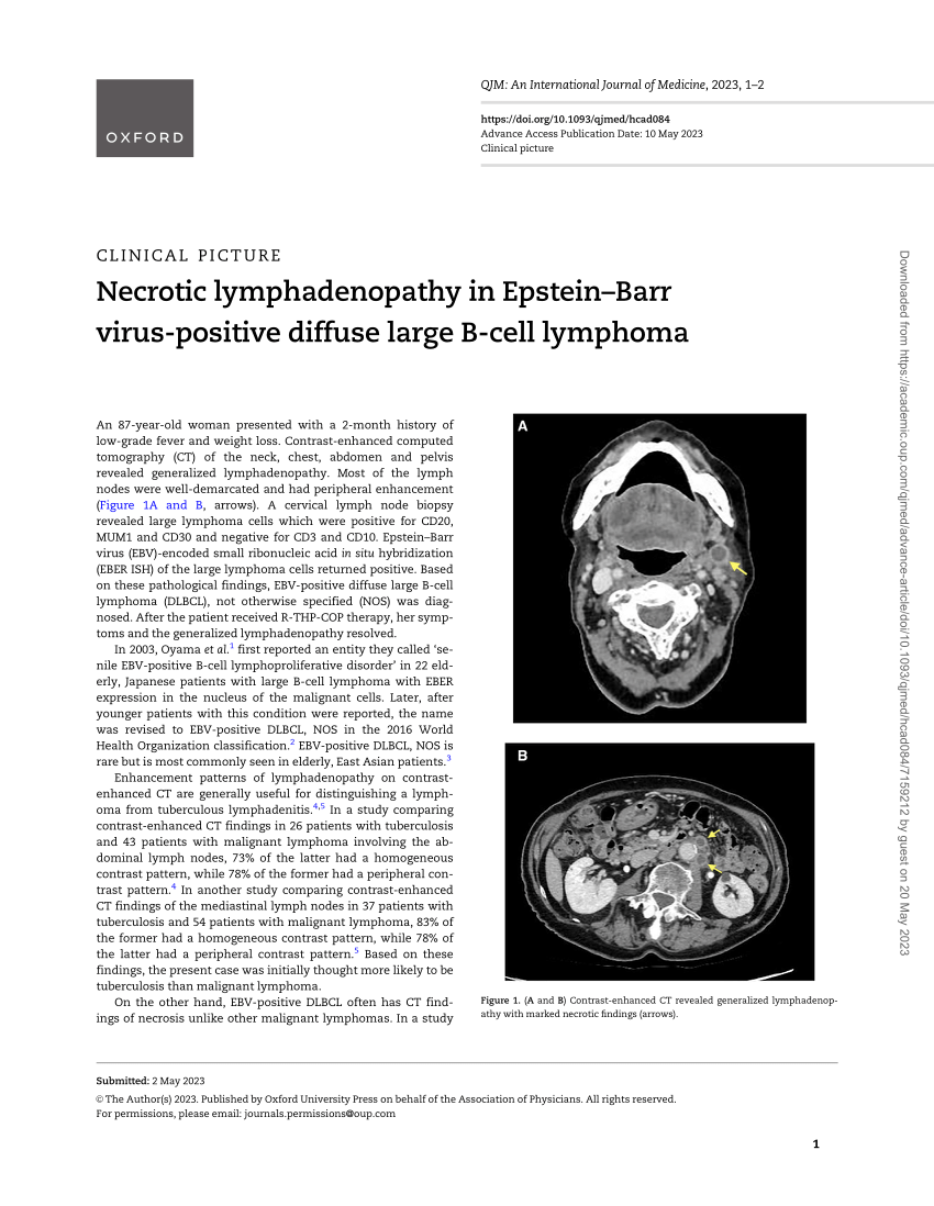 Pdf Necrotic Lymphadenopathy In Epstein Barr Virus Positive Diffuse