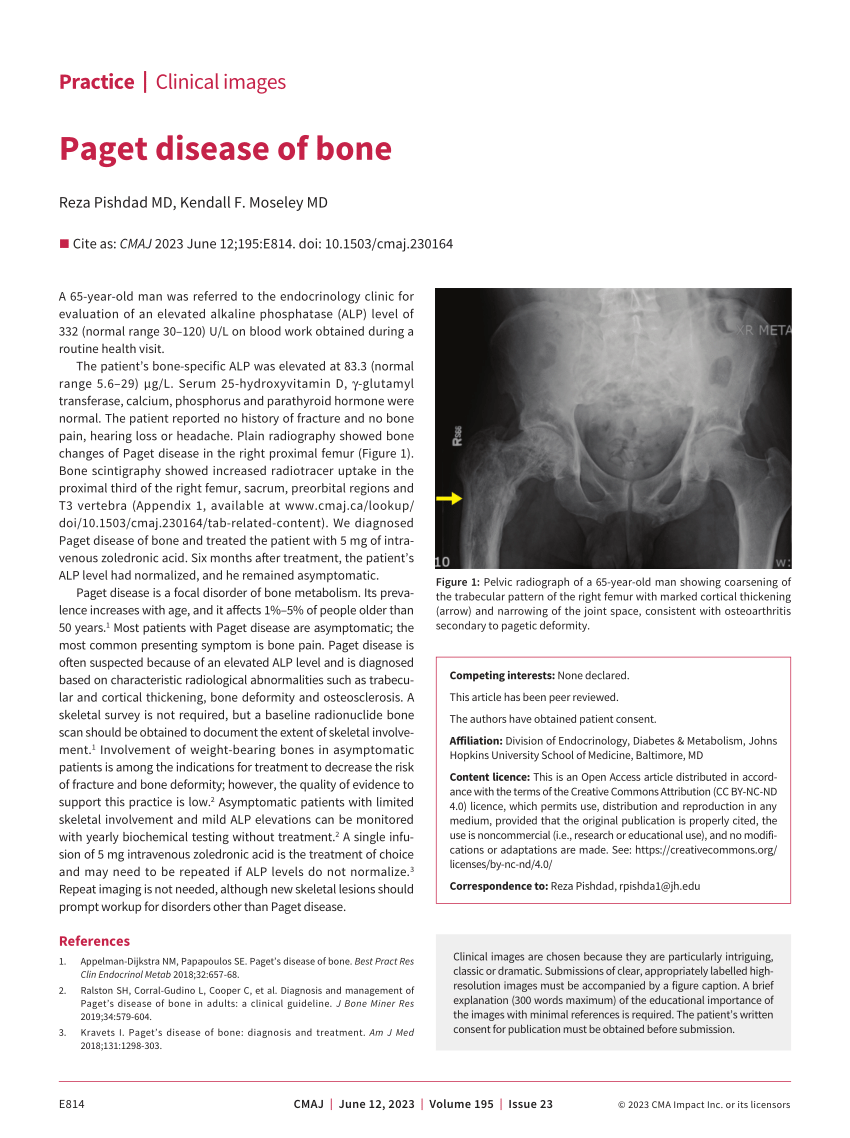 (PDF) Paget disease of bone