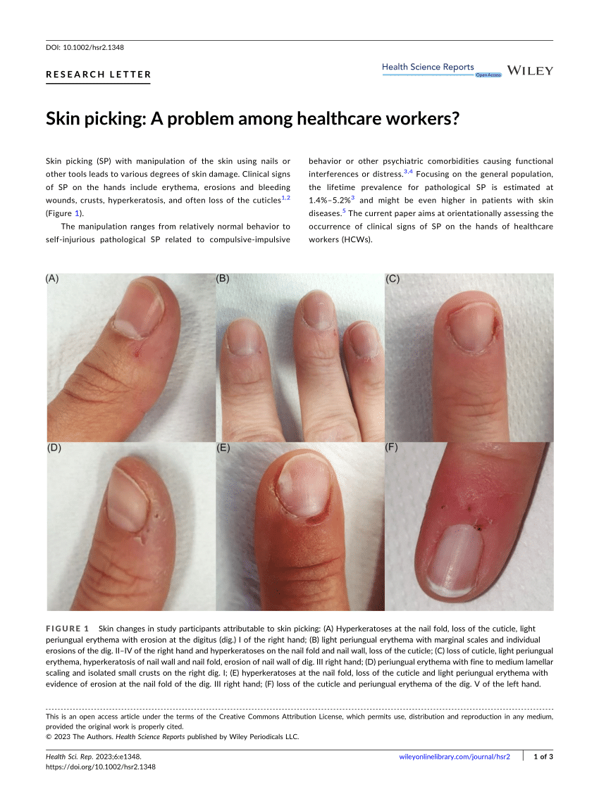 Coral-bead Skin Lesions Associated with Erosive Arthritis: A Quiz | HTML |  Acta Dermato-Venereologica