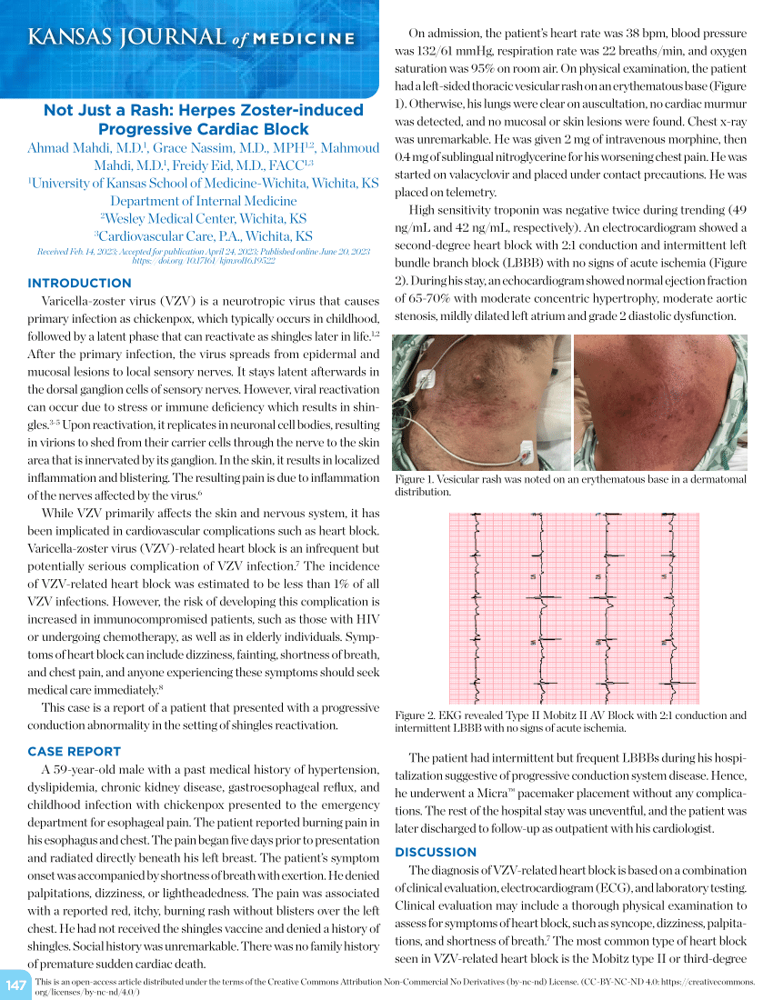 Pdf Not Just A Rash Herpes Zoster Induced Progressive Cardiac Block 2577