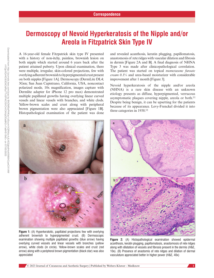 PDF) Dermoscopy of nevoid hyperkeratosis of the nipple and/or 