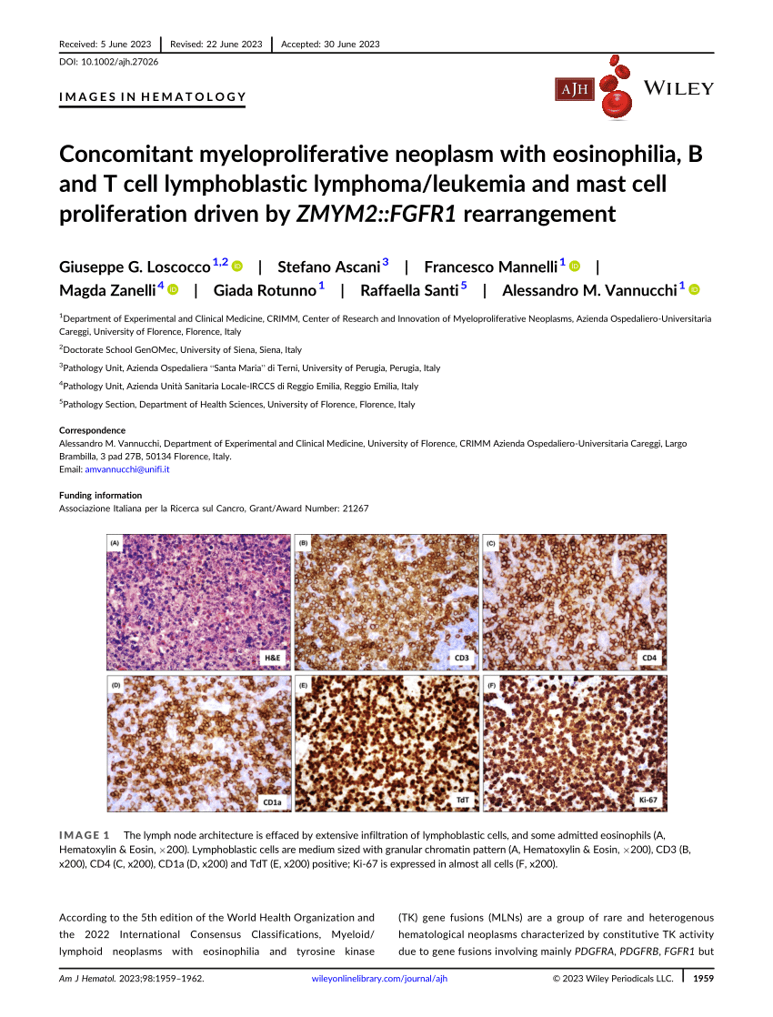 Concomitant Myeloproliferative Neoplasm With Eosinophilia B And T Cell Lymphoblastic Lymphoma 