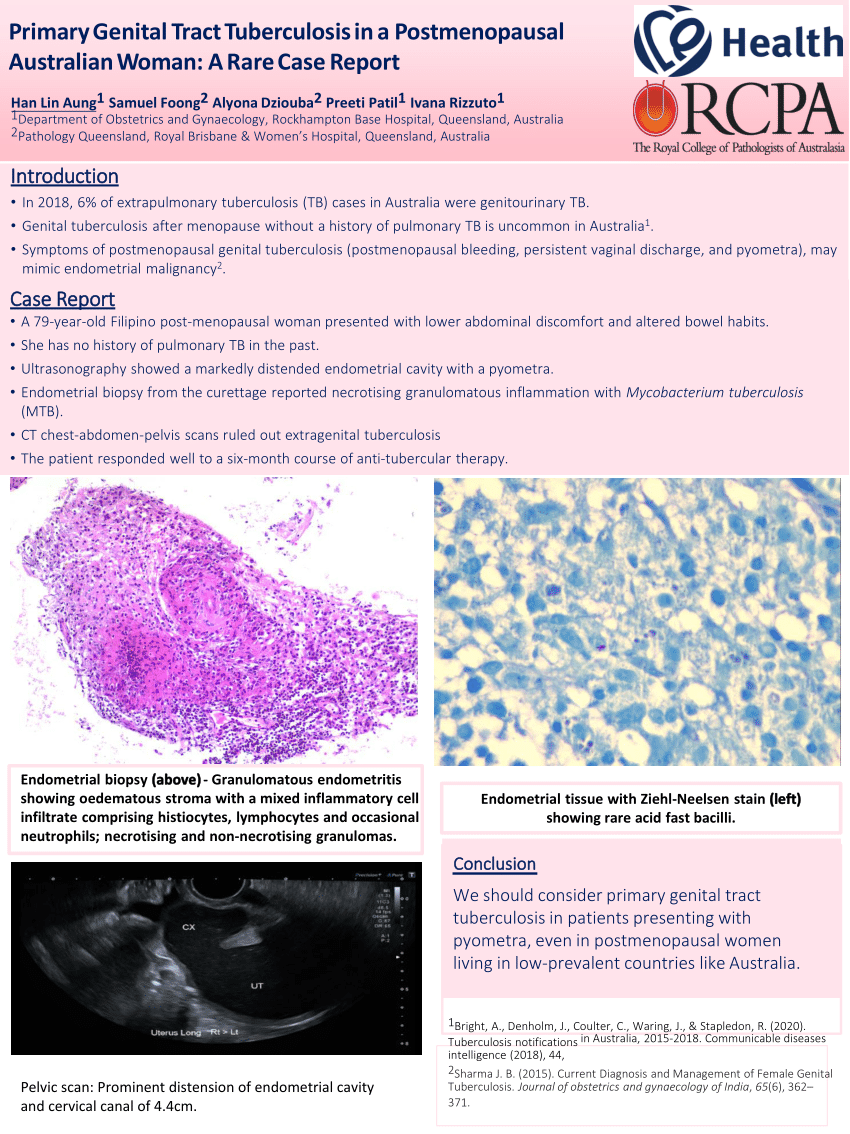 https://i1.rgstatic.net/publication/375773970_Primary_Genital_Tract_Tubercolosis_in_a_post-menopausal_Australian_womana_rare_case_report/links/655c76f4ce88b87031fbbf2b/largepreview.png