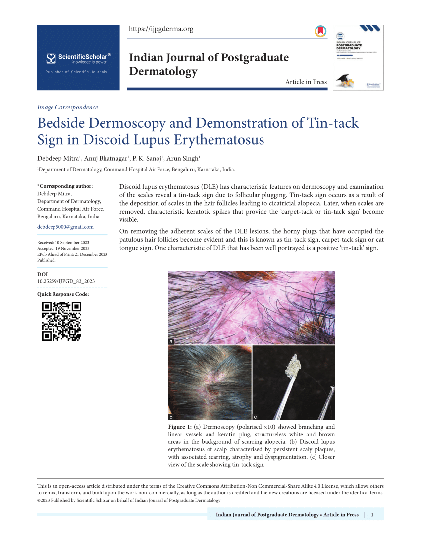 Pdf Bedside Dermoscopy And Demonstration Of Tin Tack Sign In Discoid Lupus Erythematosus