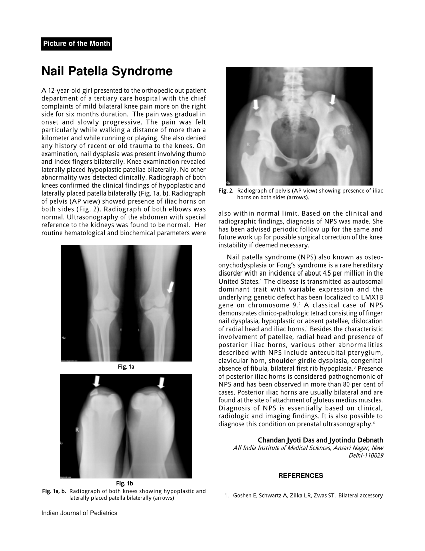 PDF) Nail patella syndrome