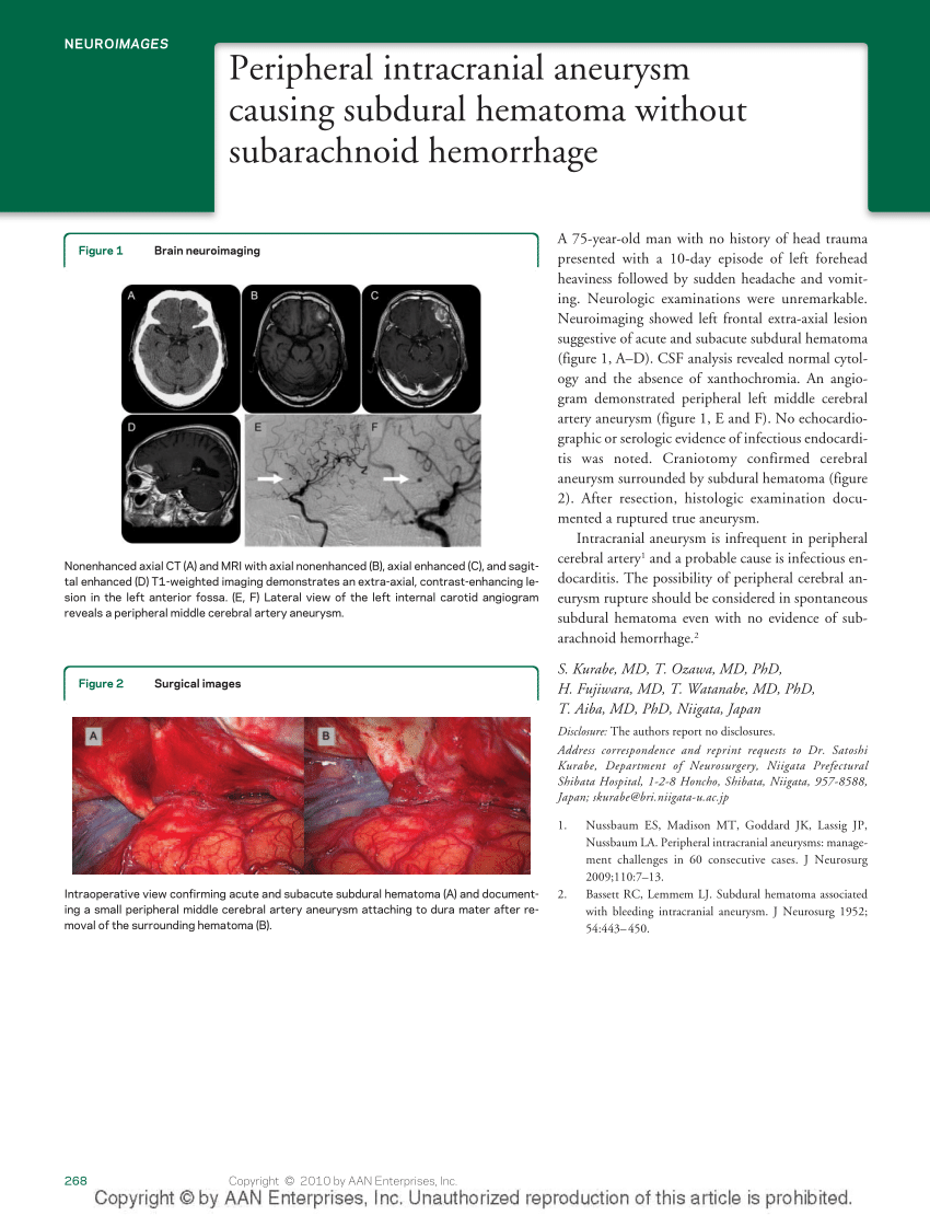 PDF Peripheral Intracranial Aneurysm Causing Subdural Hematoma Without Subarachnoid Hemorrhage