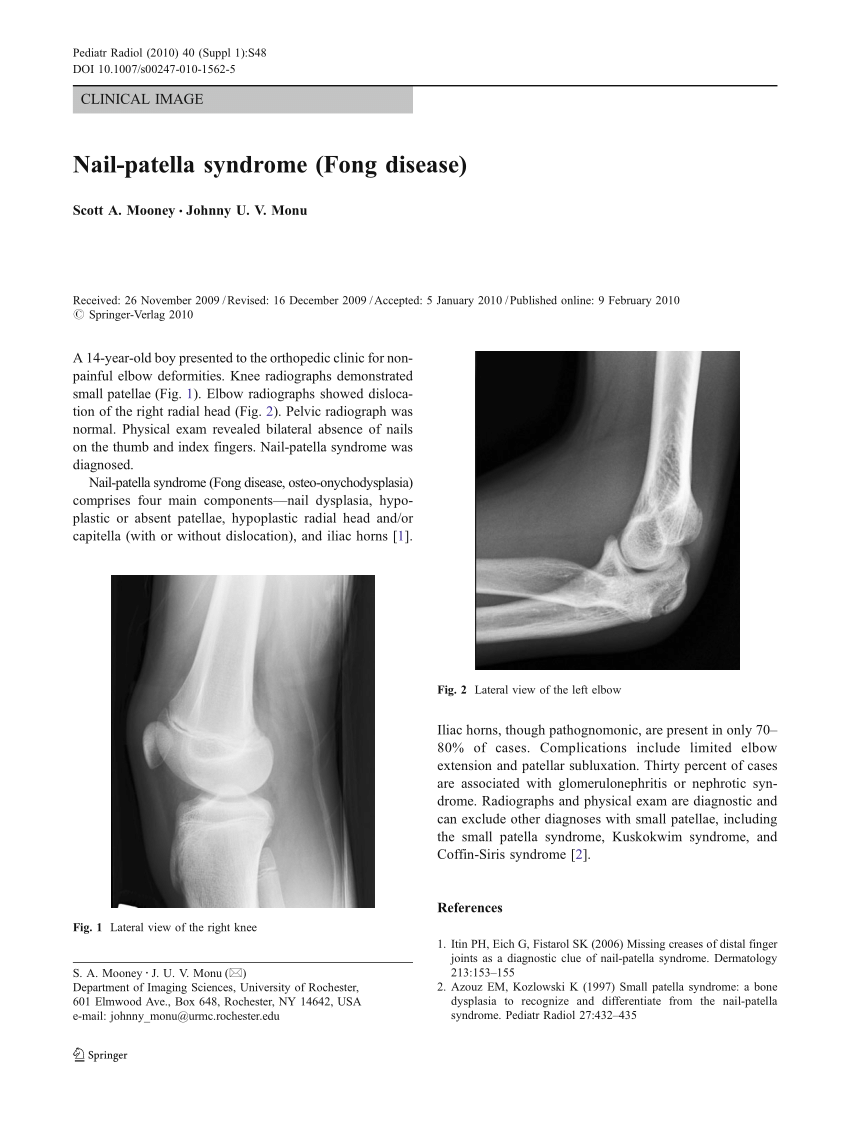 PDF) Nail-patella syndrome (Fong disease)