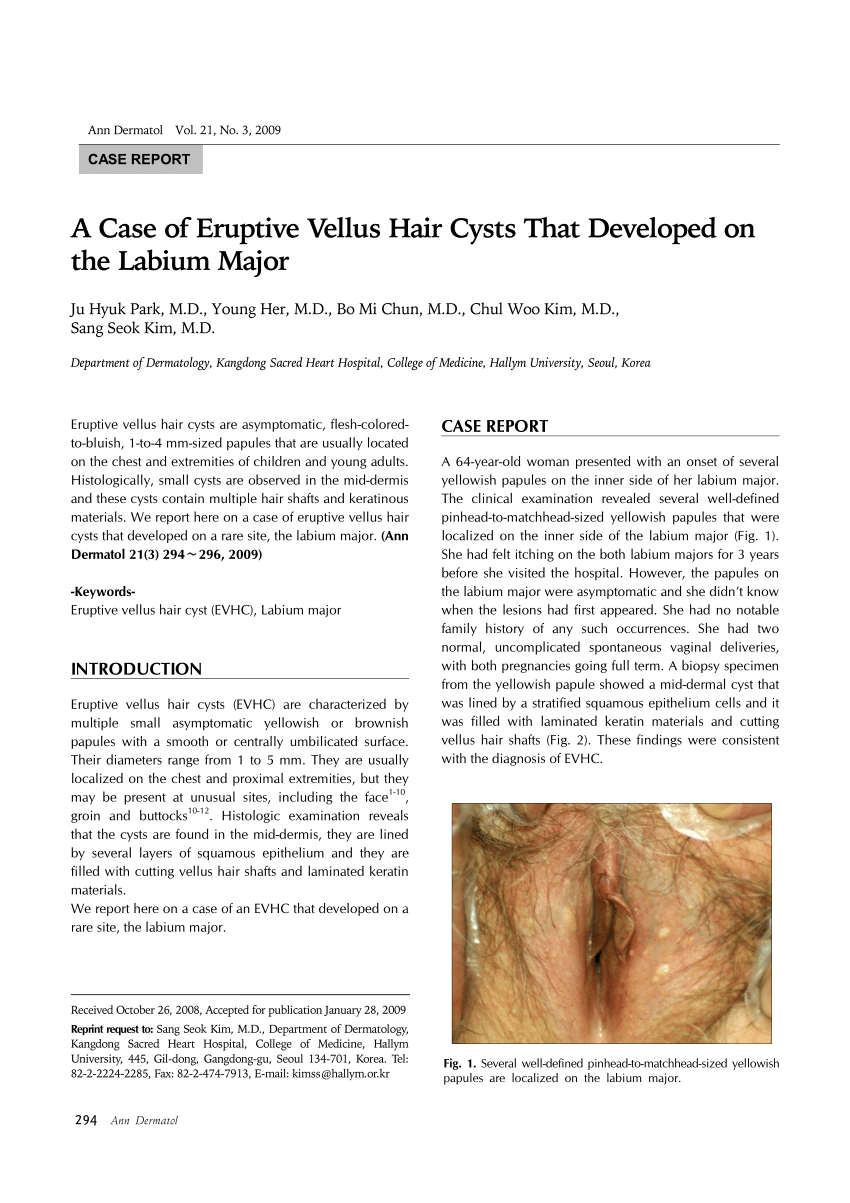 PDF) A Case of Eruptive Vellus Hair Cysts That Developed on the Labium Major