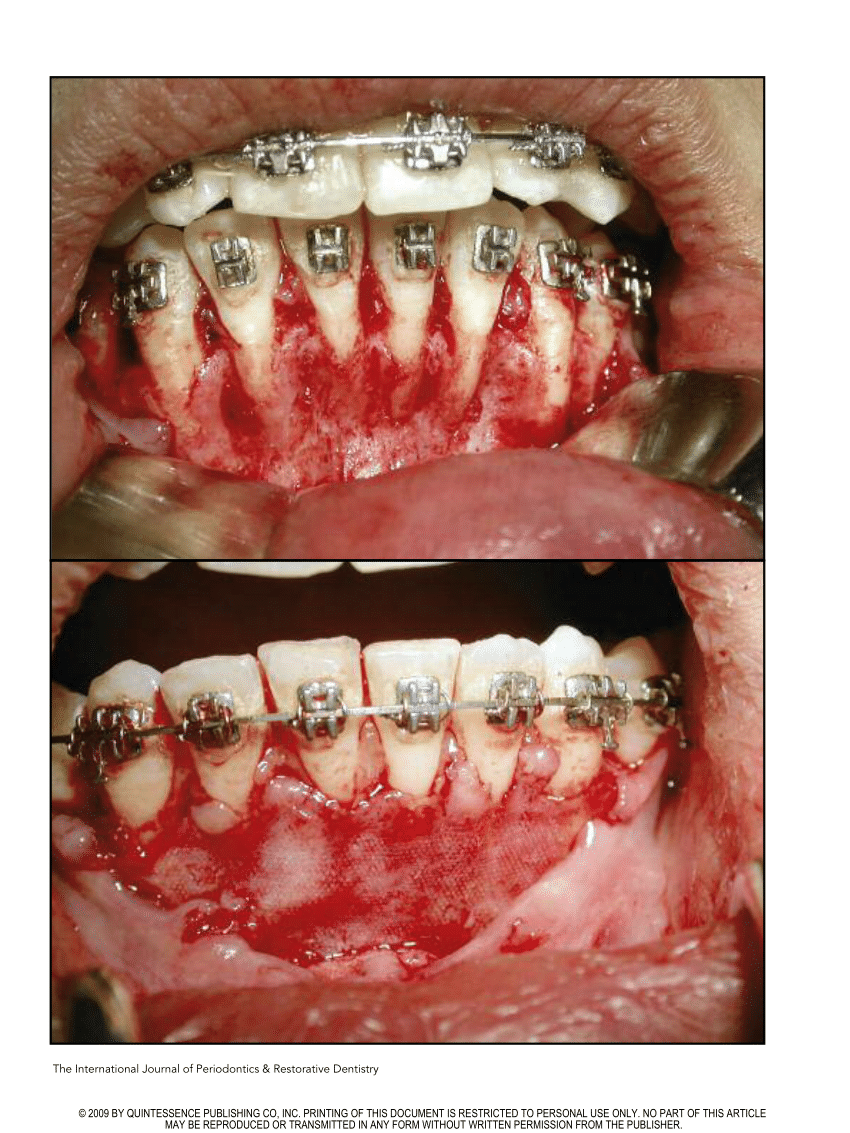 Dental Tip Out Bins, GP, Ortho, Perio