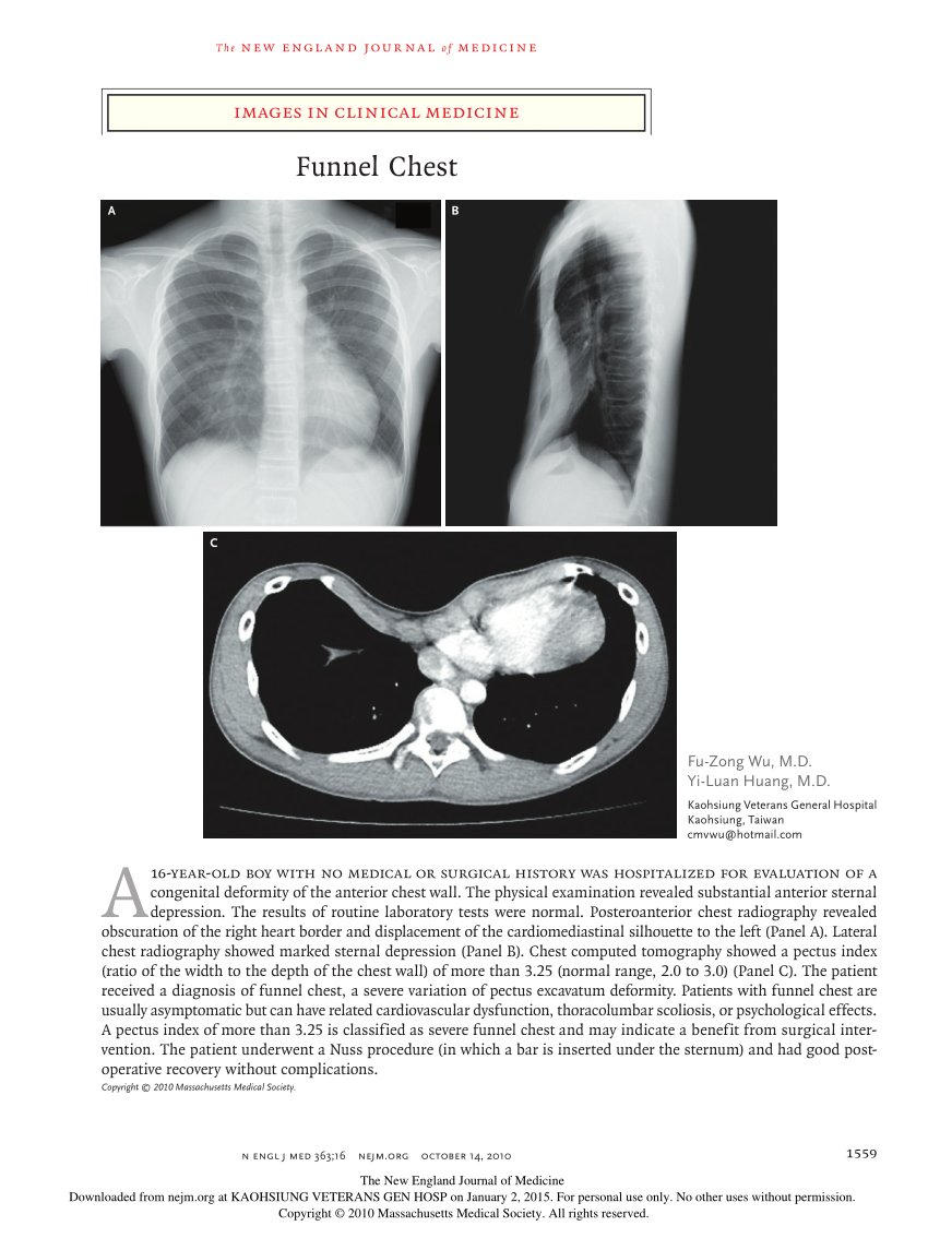 (PDF) Images in clinical medicine. Funnel chest