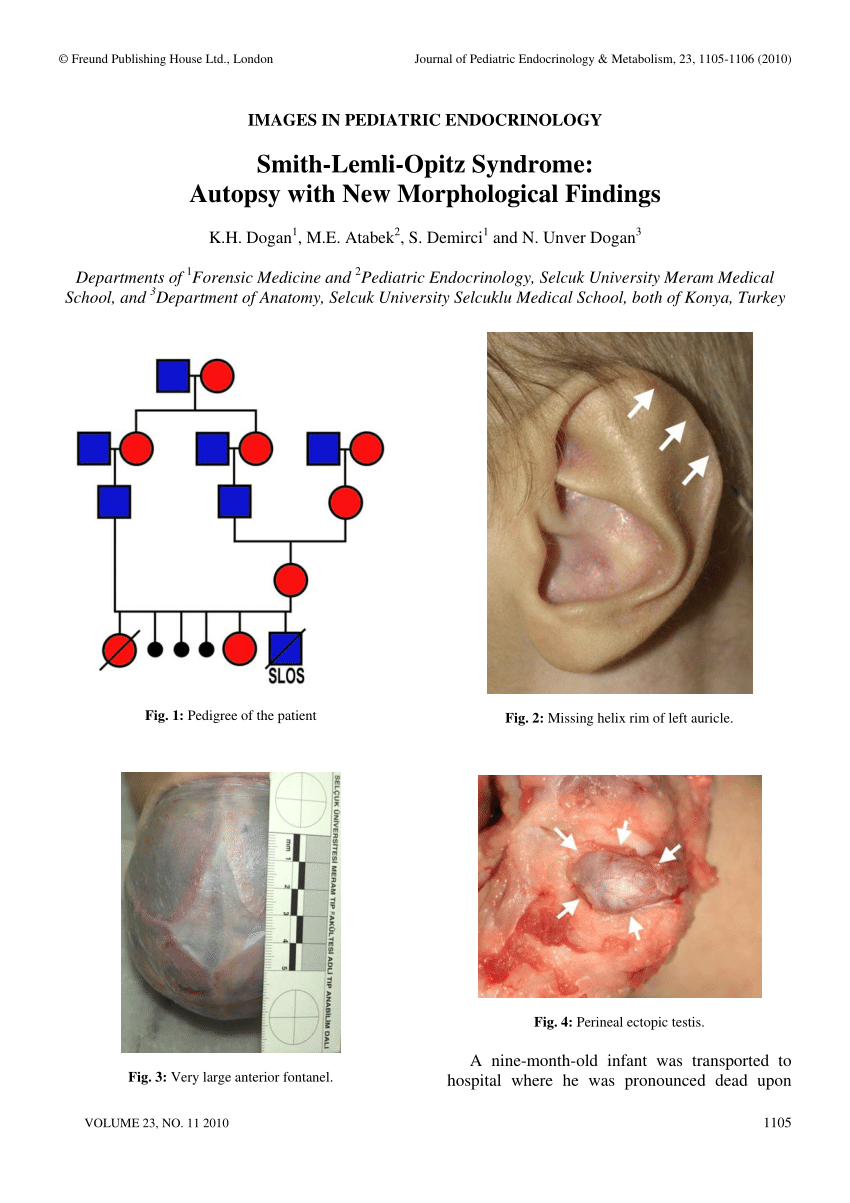 (PDF) Smith-Lemli-Opitz Syndrome: Autopsy with New Morphological Findings