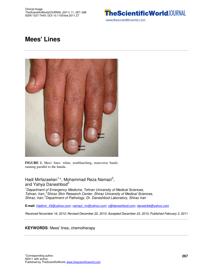 Nail involvement in pustular psoriasis of the palms and soles... | Download  Scientific Diagram