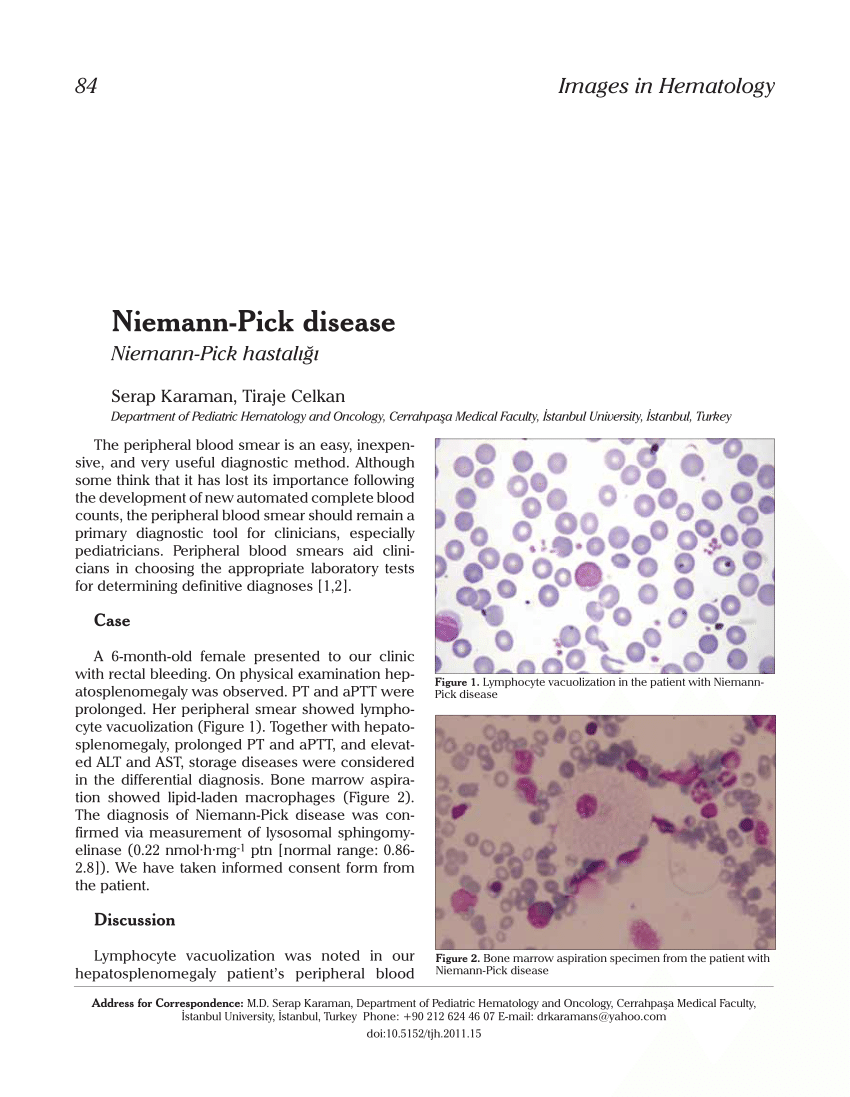 Doença de Niemann-Pick – Wikipédia, a enciclopédia livre