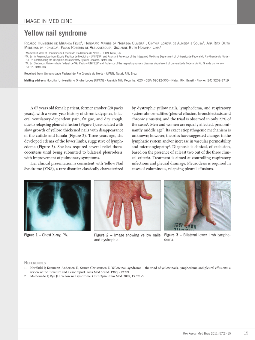 Thoracic surgical implications of the yellow nail syndrome