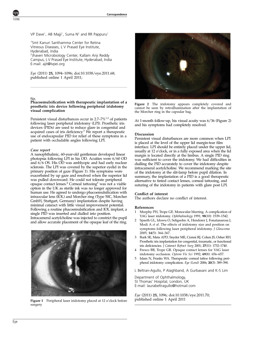 PDF) Phacoemulsification with therapeutic implantation of a prosthetic iris  device following peripheral iridotomy visual complication
