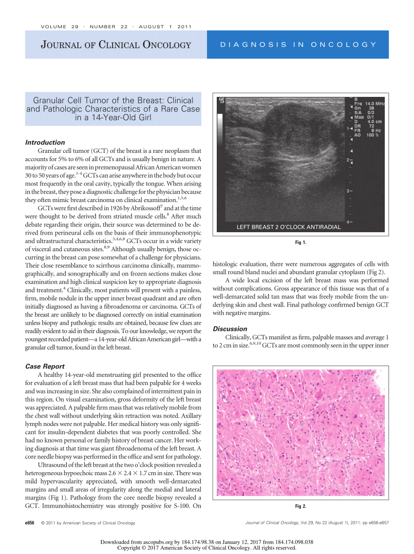 Pdf Granular Cell Tumor Of The Breast Clinical And Pathologic Characteristics Of A Rare Case