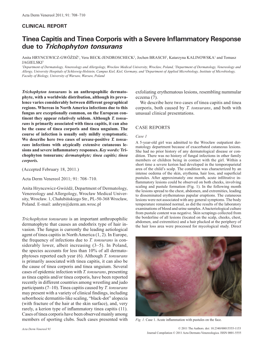 Tinea Capitis Caused by Trichophyton Tonsurans