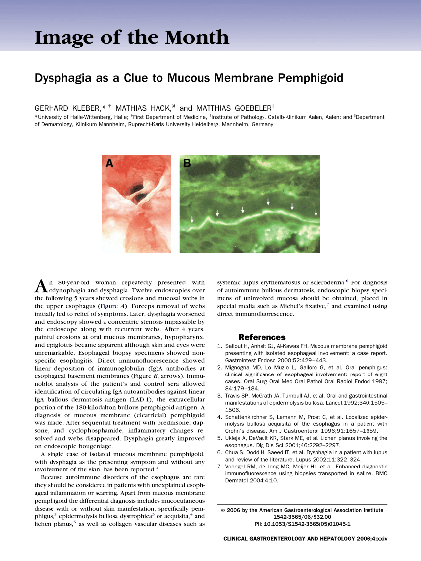 (PDF) Dysphagia as a Clue to Mucous Membrane Pemphigoid