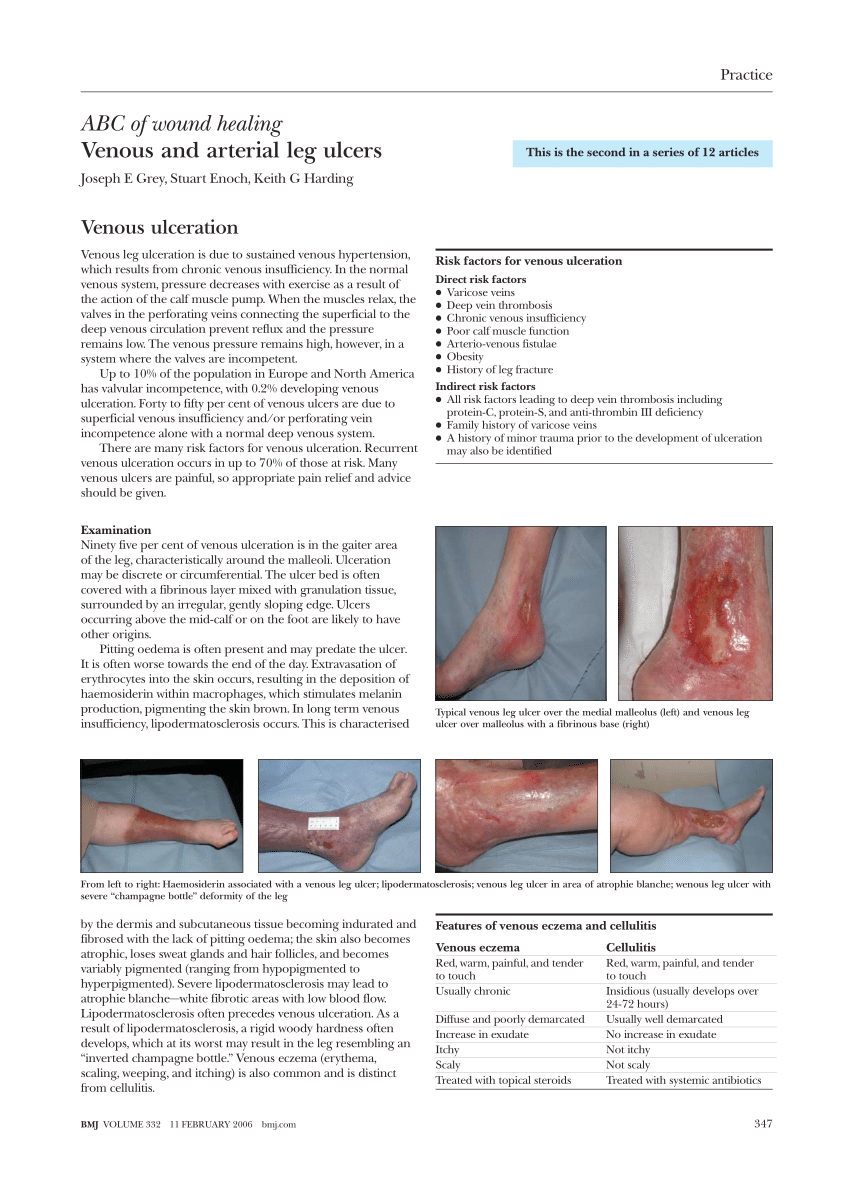 Leg Ulcer Wound Care