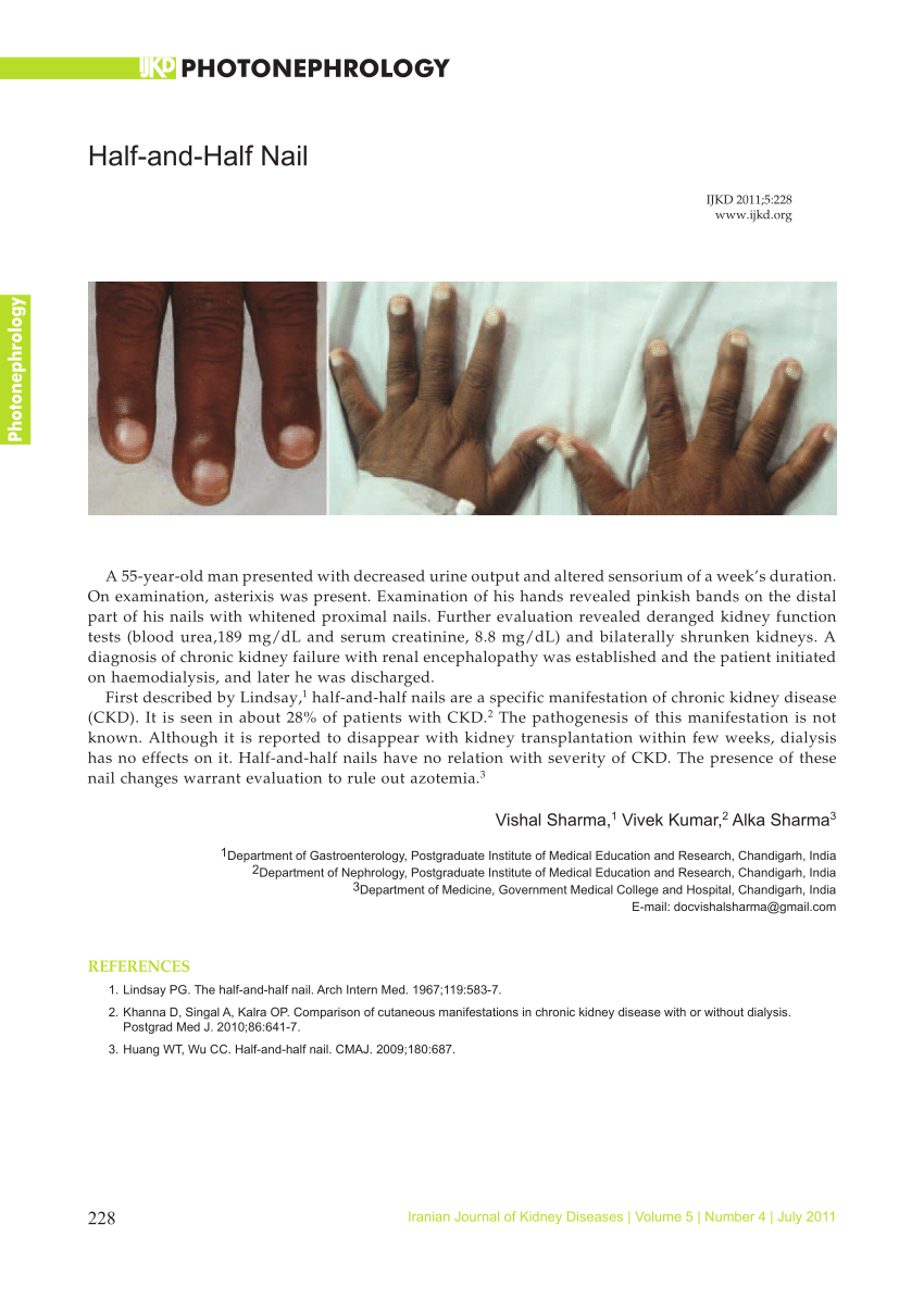 Nail dyschromias - Indian Journal of Dermatology, Venereology and Leprology