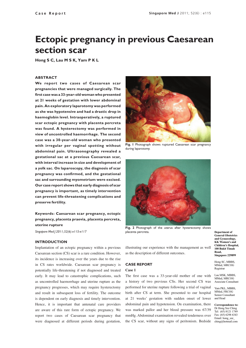 Cesarean Scar Pregnancy 