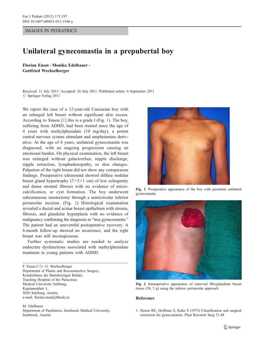 PDF Unilateral gynecomastia in a prepubertal boy