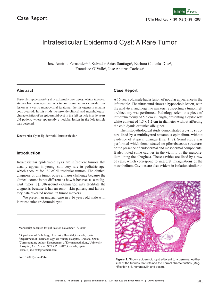 Pdf Intratesticular Epidermoid Cyst A Rare Tumor Hot Sex Picture 2085