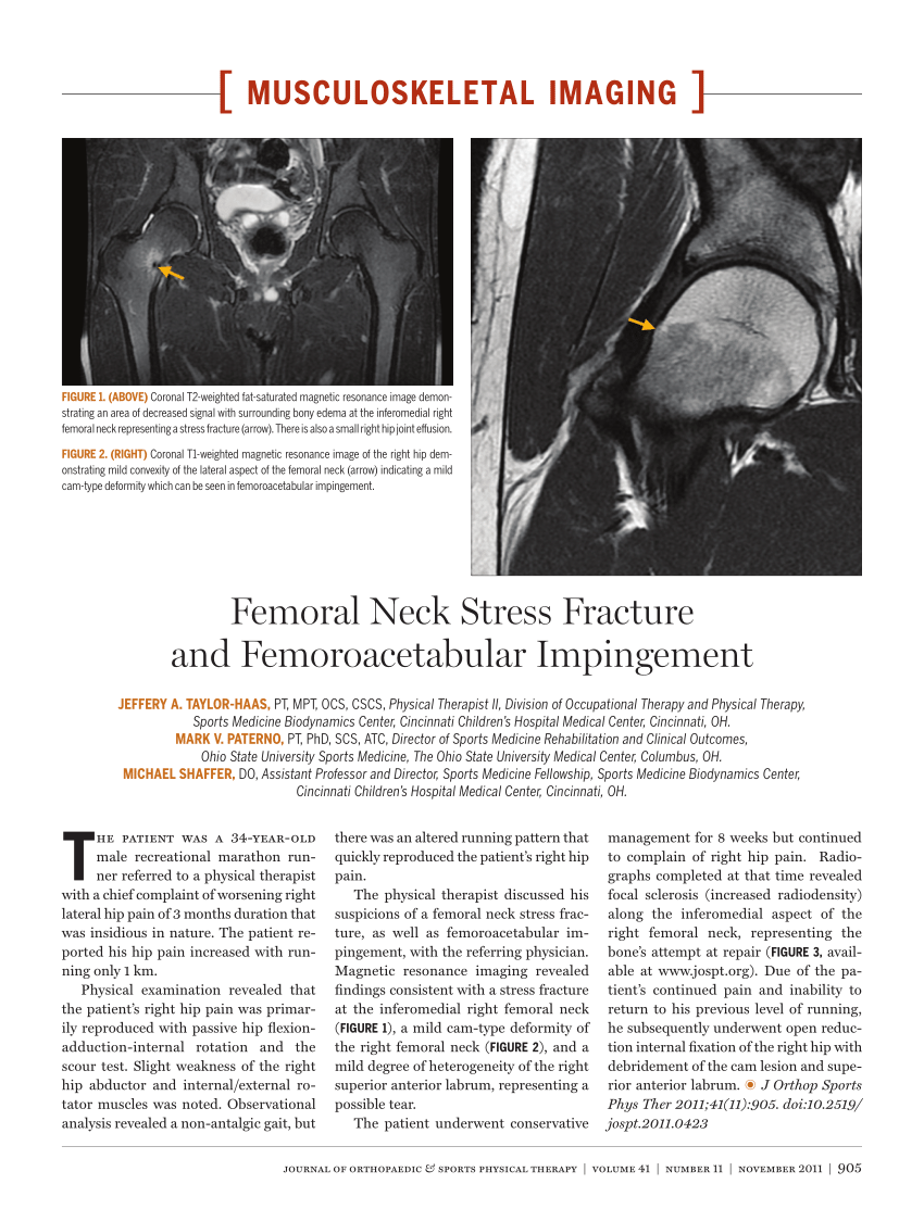 Pdf Femoral Neck Stress Fracture And Femoroacetabular Impingement 8285