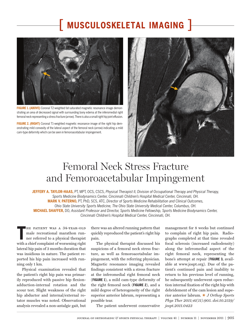 PDF Femoral Neck Stress Fracture And Femoroacetabular Impingement