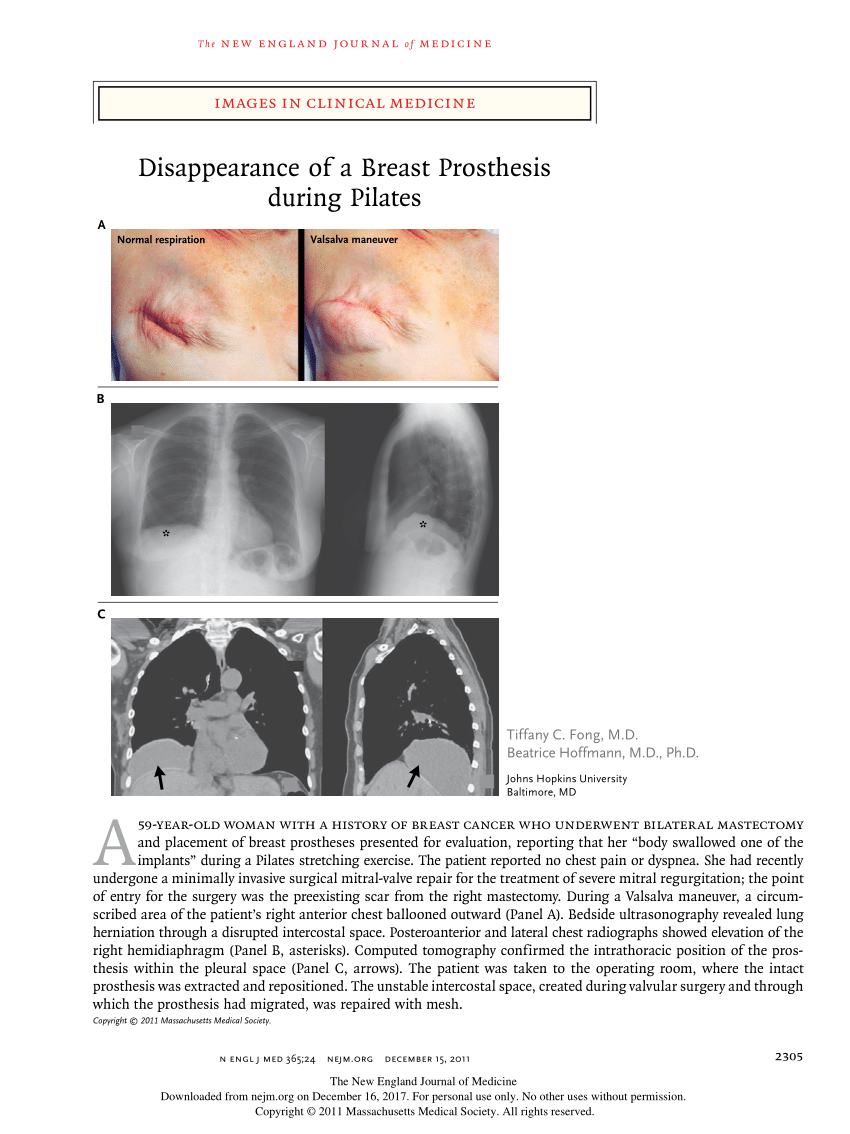 Pdf Images In Clinical Medicine Disappearance Of A Breast Prosthesis During Pilates 7969